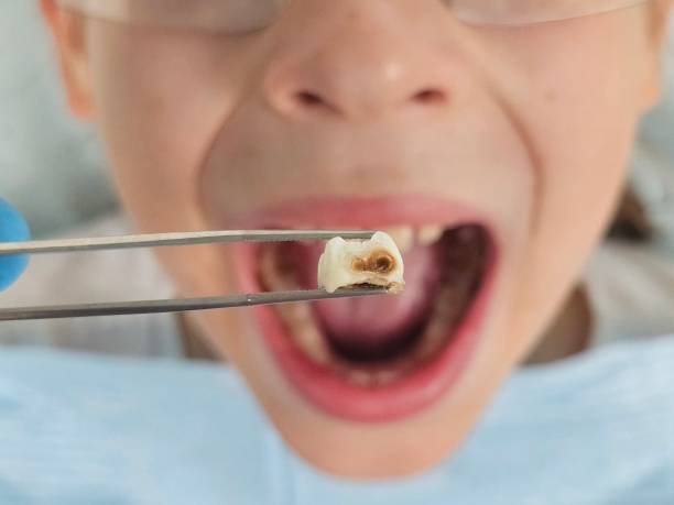 Best Emergency Root Canal Therapy in Westlake Vlage, IL